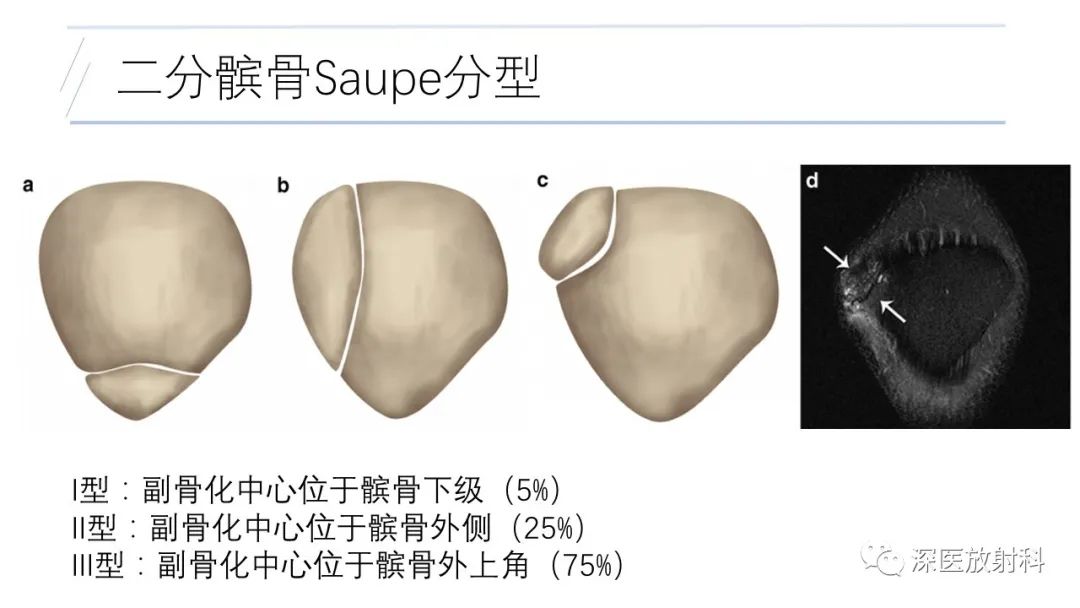影像PPT - 【PPT】膝关节解剖变异的影像诊断-19