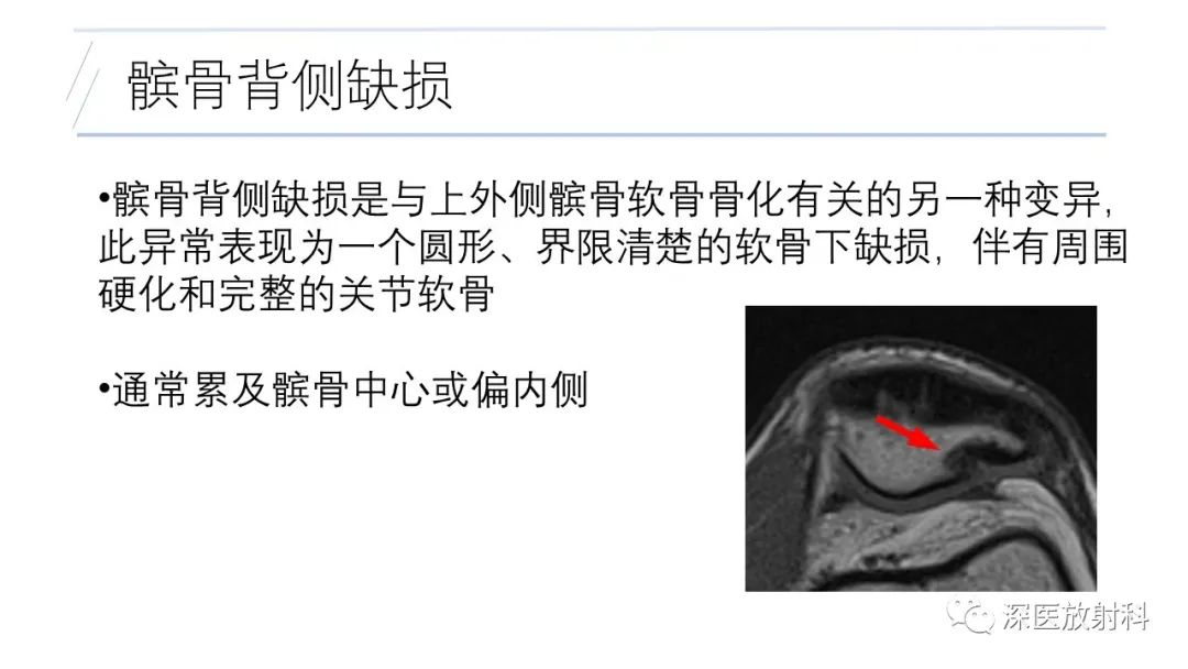 影像PPT - 【PPT】膝关节解剖变异的影像诊断-20