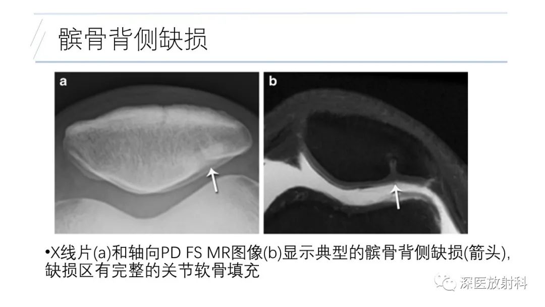 影像PPT - 【PPT】膝关节解剖变异的影像诊断-21