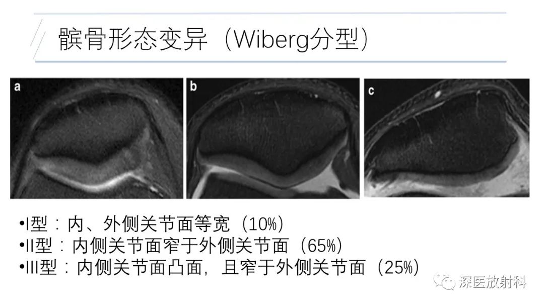 影像PPT - 【PPT】膝关节解剖变异的影像诊断-22
