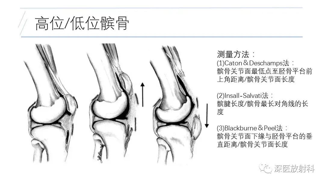 影像PPT - 【PPT】膝关节解剖变异的影像诊断-23