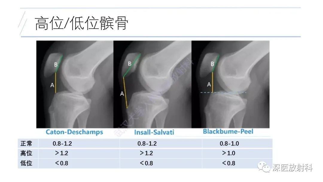 影像PPT - 【PPT】膝关节解剖变异的影像诊断-24