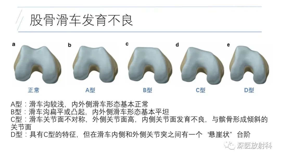 影像PPT - 【PPT】膝关节解剖变异的影像诊断-25
