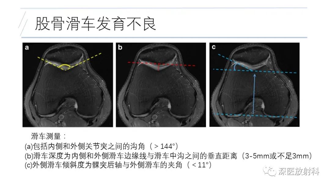 影像PPT - 【PPT】膝关节解剖变异的影像诊断-26