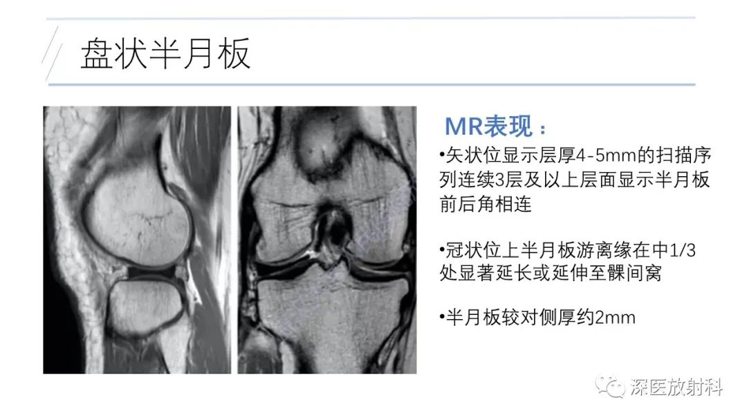 影像PPT - 【PPT】膝关节解剖变异的影像诊断-29