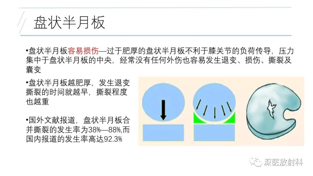 影像PPT - 【PPT】膝关节解剖变异的影像诊断-28