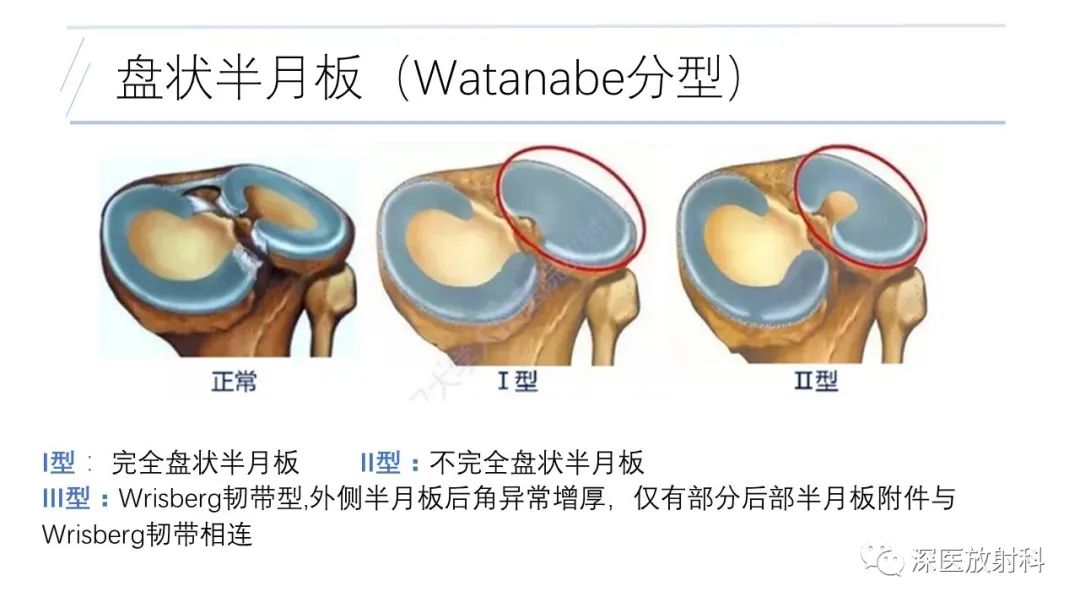 影像PPT - 【PPT】膝关节解剖变异的影像诊断-30