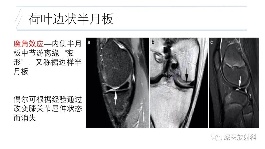 影像PPT - 【PPT】膝关节解剖变异的影像诊断-31