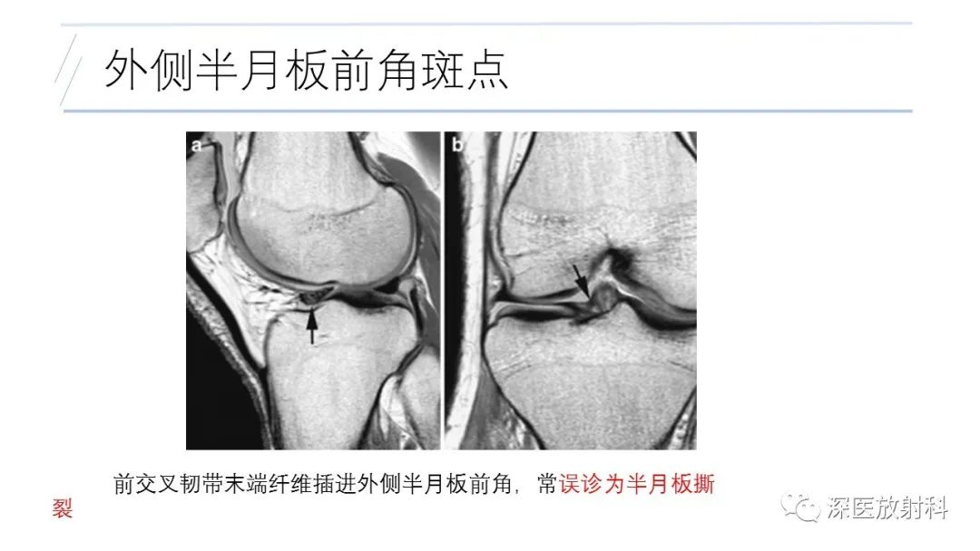 影像PPT - 【PPT】膝关节解剖变异的影像诊断-32