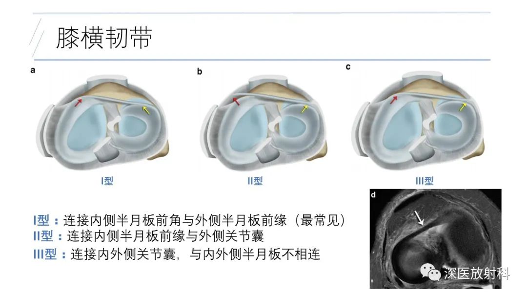 影像PPT - 【PPT】膝关节解剖变异的影像诊断-34