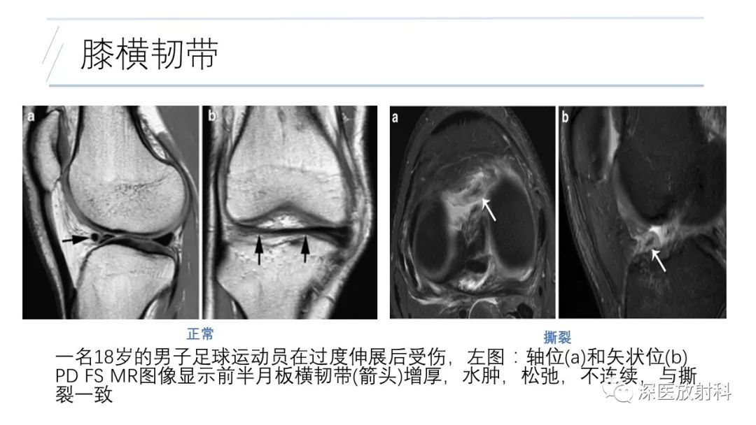 影像PPT - 【PPT】膝关节解剖变异的影像诊断-35
