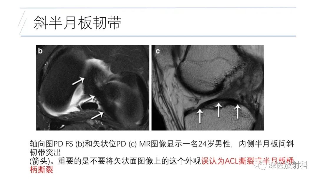 影像PPT - 【PPT】膝关节解剖变异的影像诊断-37