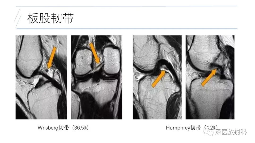 影像PPT - 【PPT】膝关节解剖变异的影像诊断-39