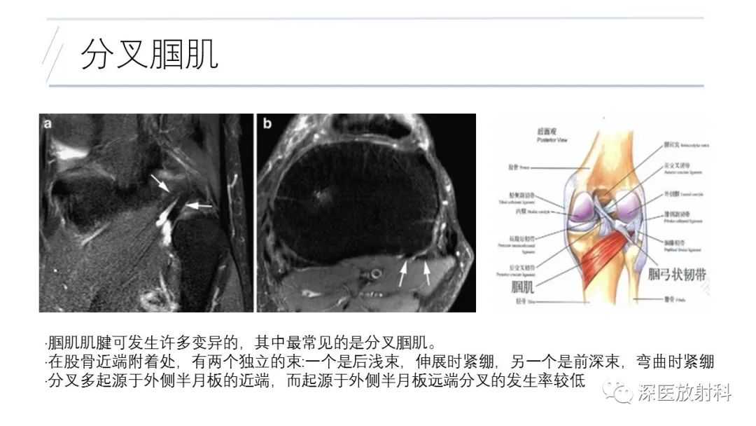影像PPT - 【PPT】膝关节解剖变异的影像诊断-42
