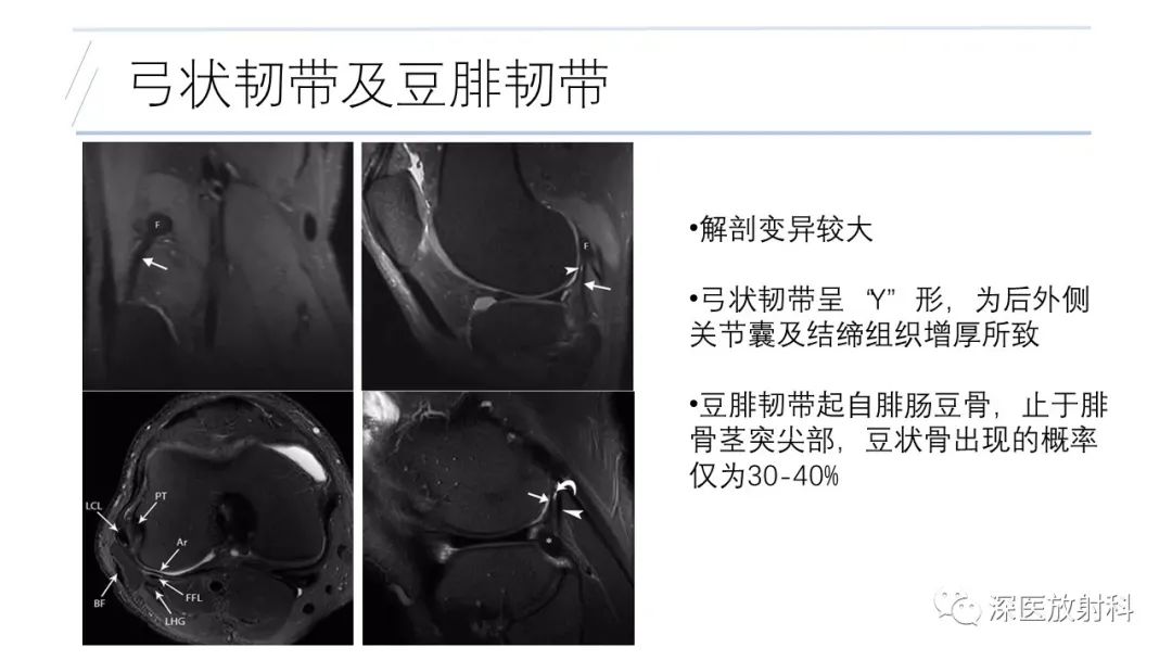 影像PPT - 【PPT】膝关节解剖变异的影像诊断-40