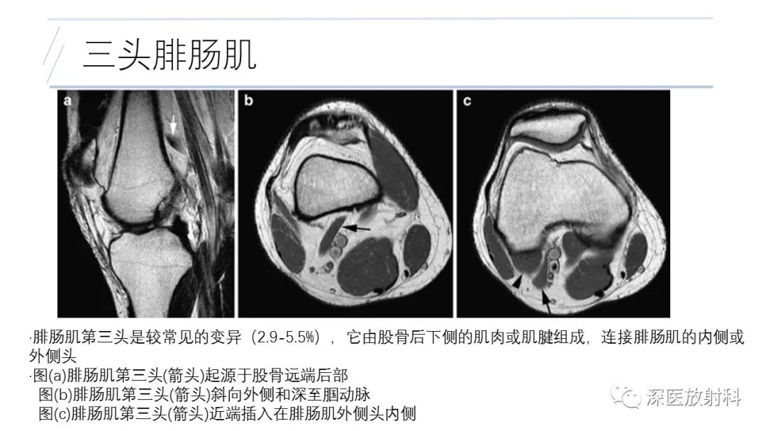 影像PPT - 【PPT】膝关节解剖变异的影像诊断-43