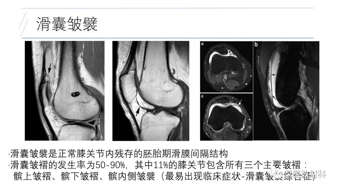 影像PPT - 【PPT】膝关节解剖变异的影像诊断-45