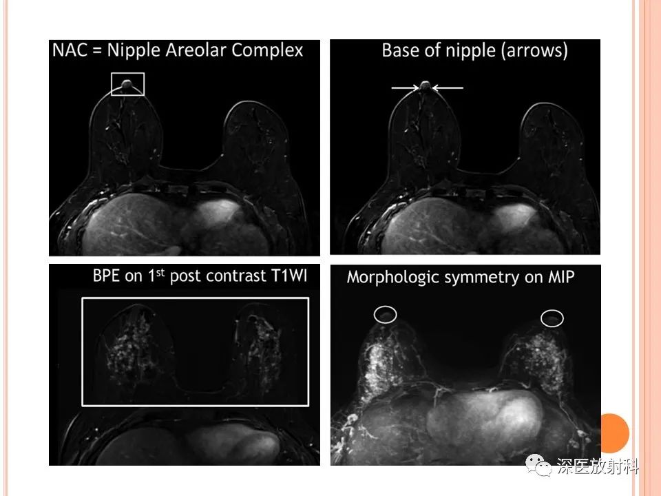 影像PPT - 乳腺MRI乳头强化及影像-病理的相关性-6