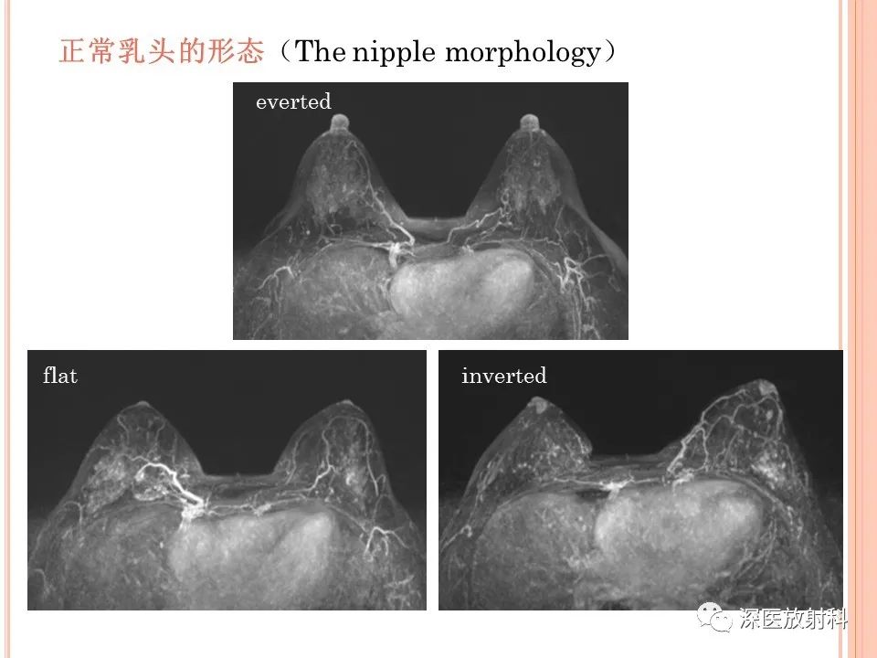 影像PPT - 乳腺MRI乳头强化及影像-病理的相关性-8