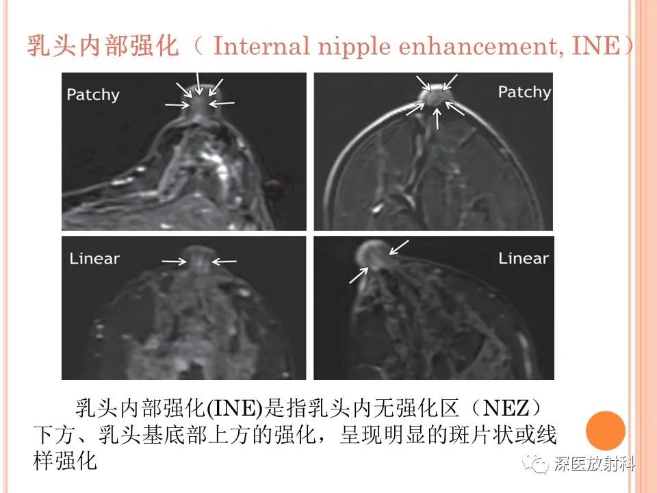 影像PPT - 乳腺MRI乳头强化及影像-病理的相关性-12