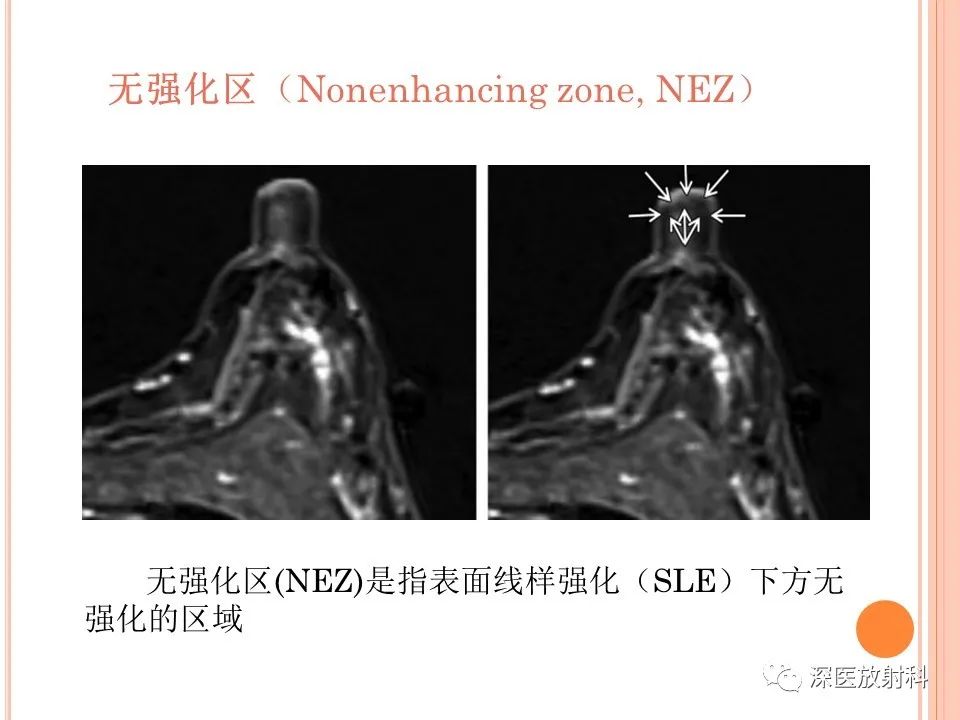 影像PPT - 乳腺MRI乳头强化及影像-病理的相关性-11