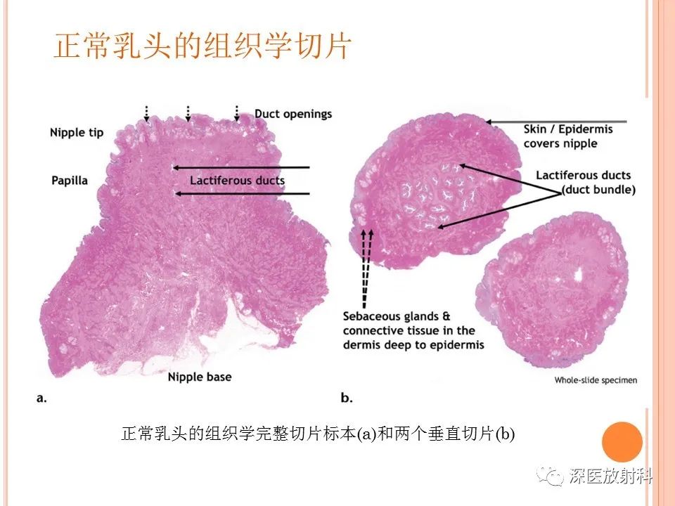 影像PPT - 乳腺MRI乳头强化及影像-病理的相关性-13