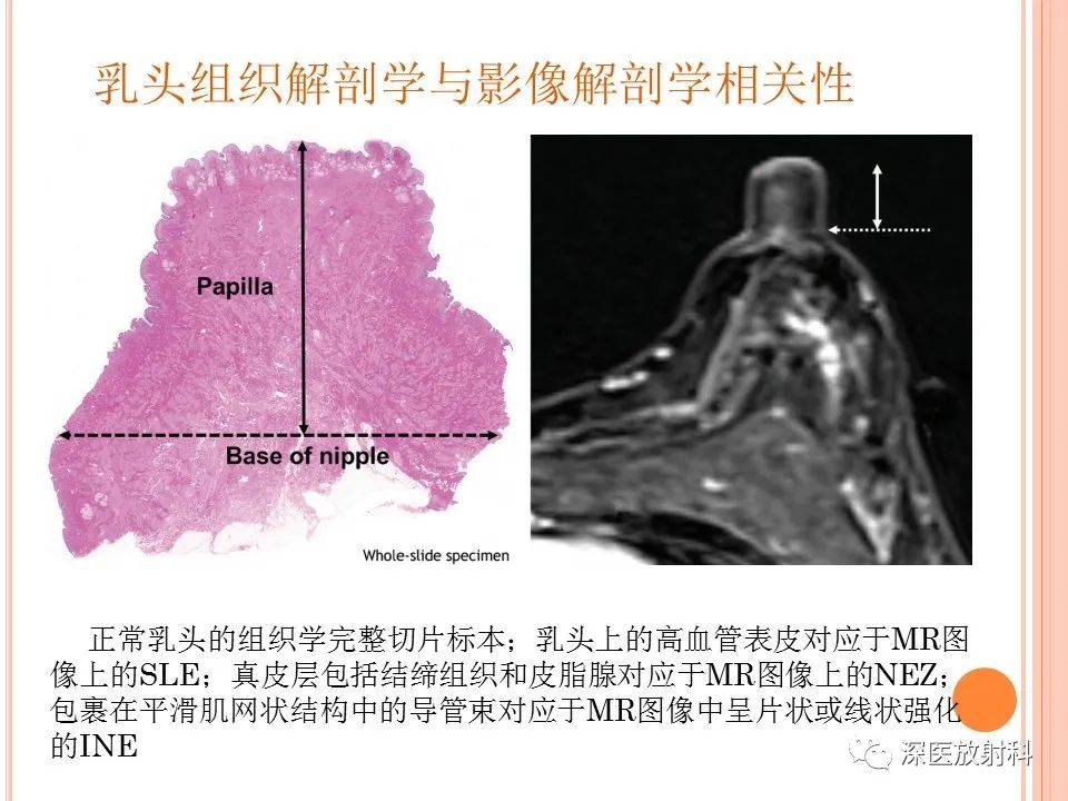 影像PPT - 乳腺MRI乳头强化及影像-病理的相关性-14
