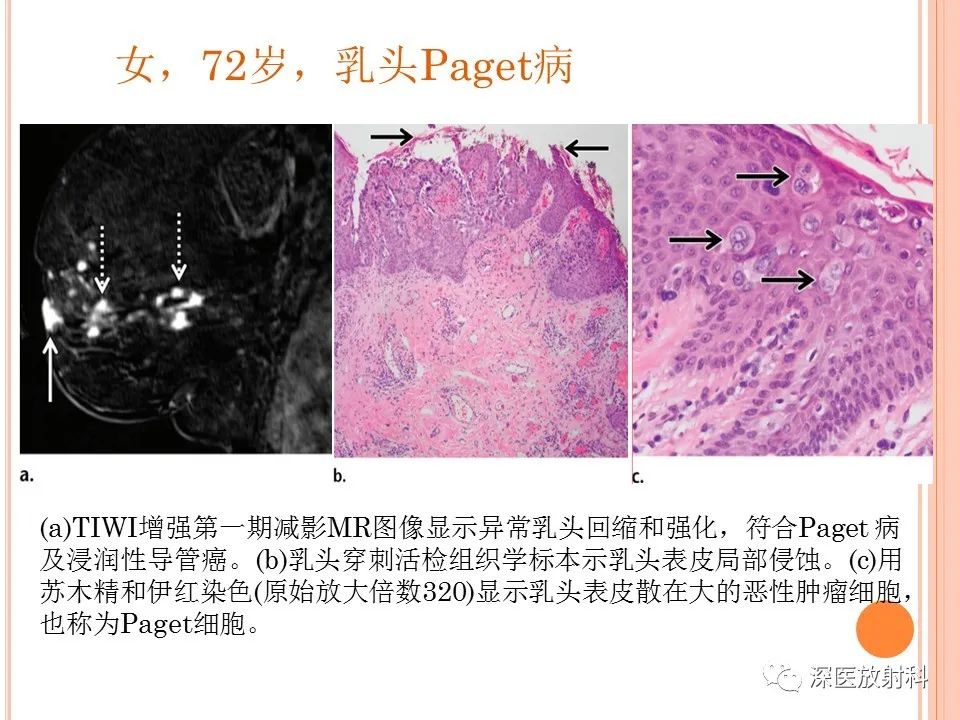 影像PPT - 乳腺MRI乳头强化及影像-病理的相关性-19