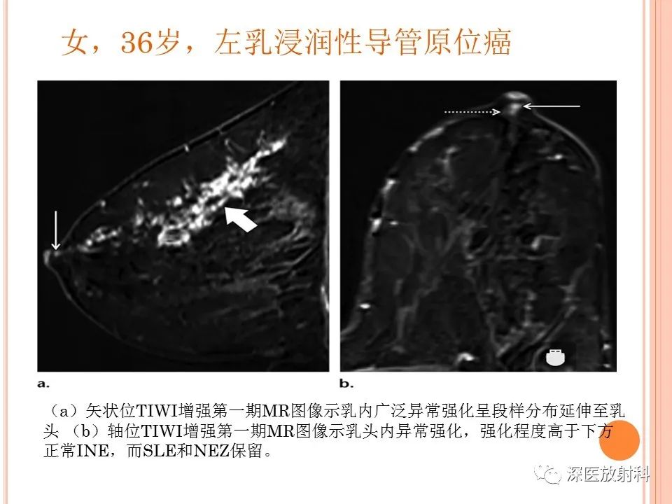 影像PPT - 乳腺MRI乳头强化及影像-病理的相关性-21