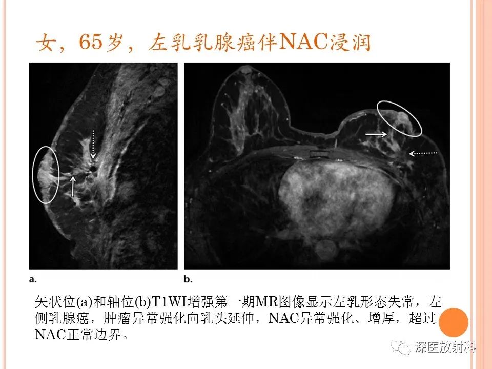影像PPT - 乳腺MRI乳头强化及影像-病理的相关性-23