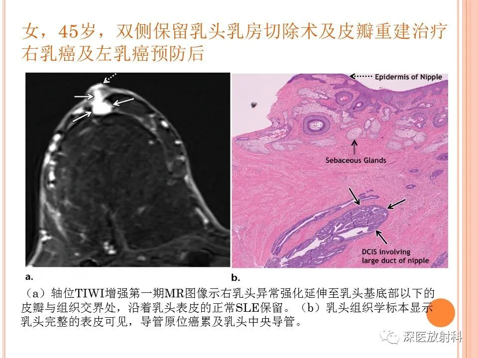 影像PPT - 乳腺MRI乳头强化及影像-病理的相关性-24