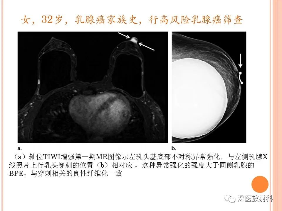 影像PPT - 乳腺MRI乳头强化及影像-病理的相关性-26