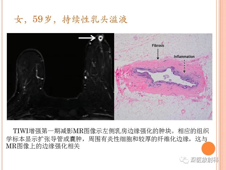影像PPT - 乳腺MRI乳头强化及影像-病理的相关性-27