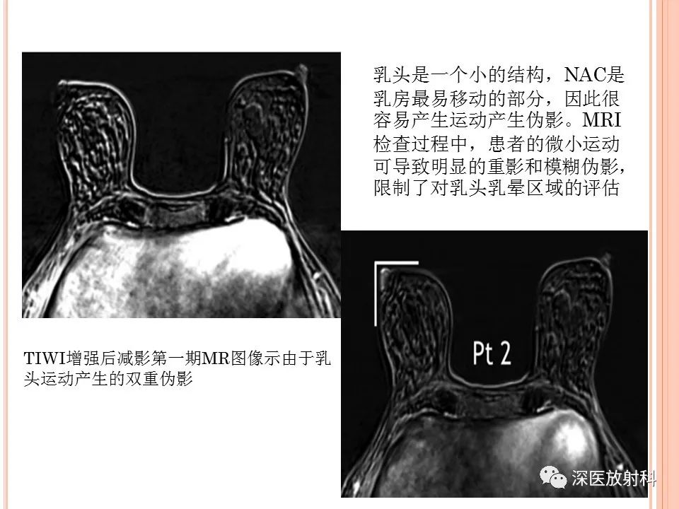 影像PPT - 乳腺MRI乳头强化及影像-病理的相关性-29
