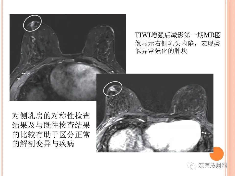 影像PPT - 乳腺MRI乳头强化及影像-病理的相关性-32
