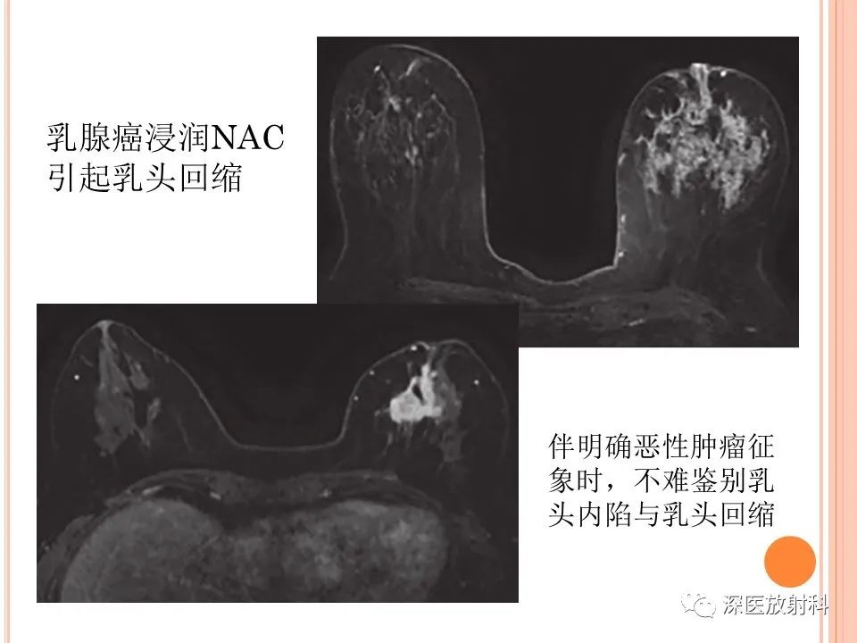 影像PPT - 乳腺MRI乳头强化及影像-病理的相关性-33