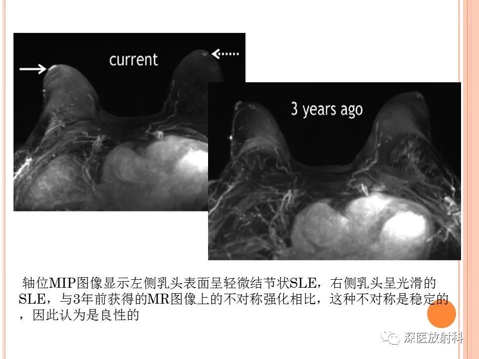 影像PPT - 乳腺MRI乳头强化及影像-病理的相关性-36