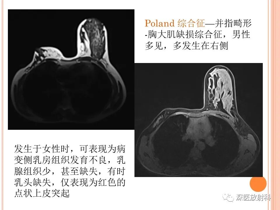 影像PPT - 乳腺MRI乳头强化及影像-病理的相关性-38