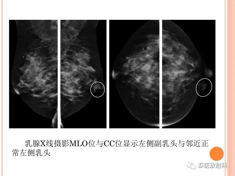 影像PPT - 乳腺MRI乳头强化及影像-病理的相关性-37