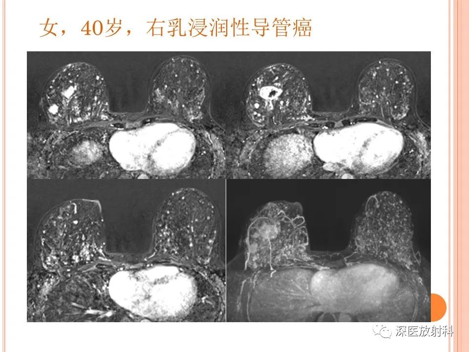 影像PPT - 乳腺MRI乳头强化及影像-病理的相关性-42