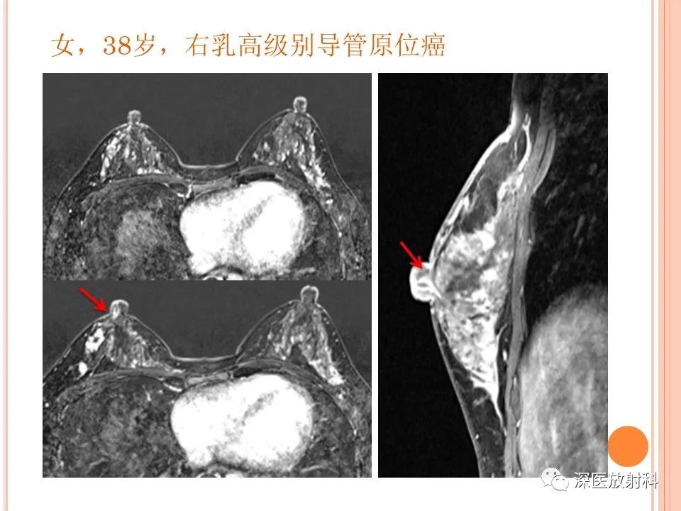 影像PPT - 乳腺MRI乳头强化及影像-病理的相关性-40
