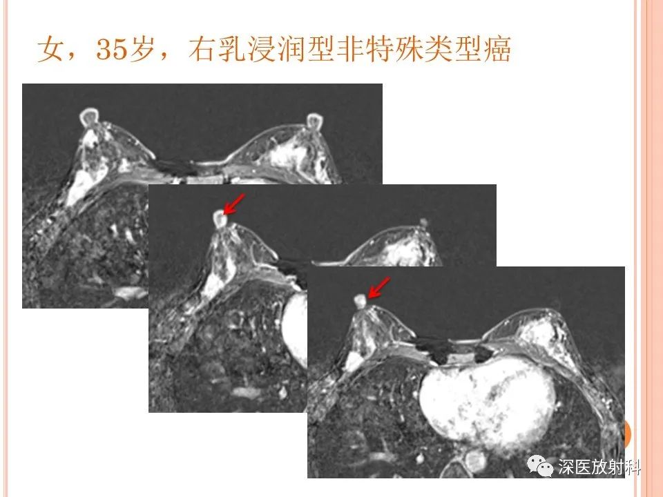 影像PPT - 乳腺MRI乳头强化及影像-病理的相关性-41