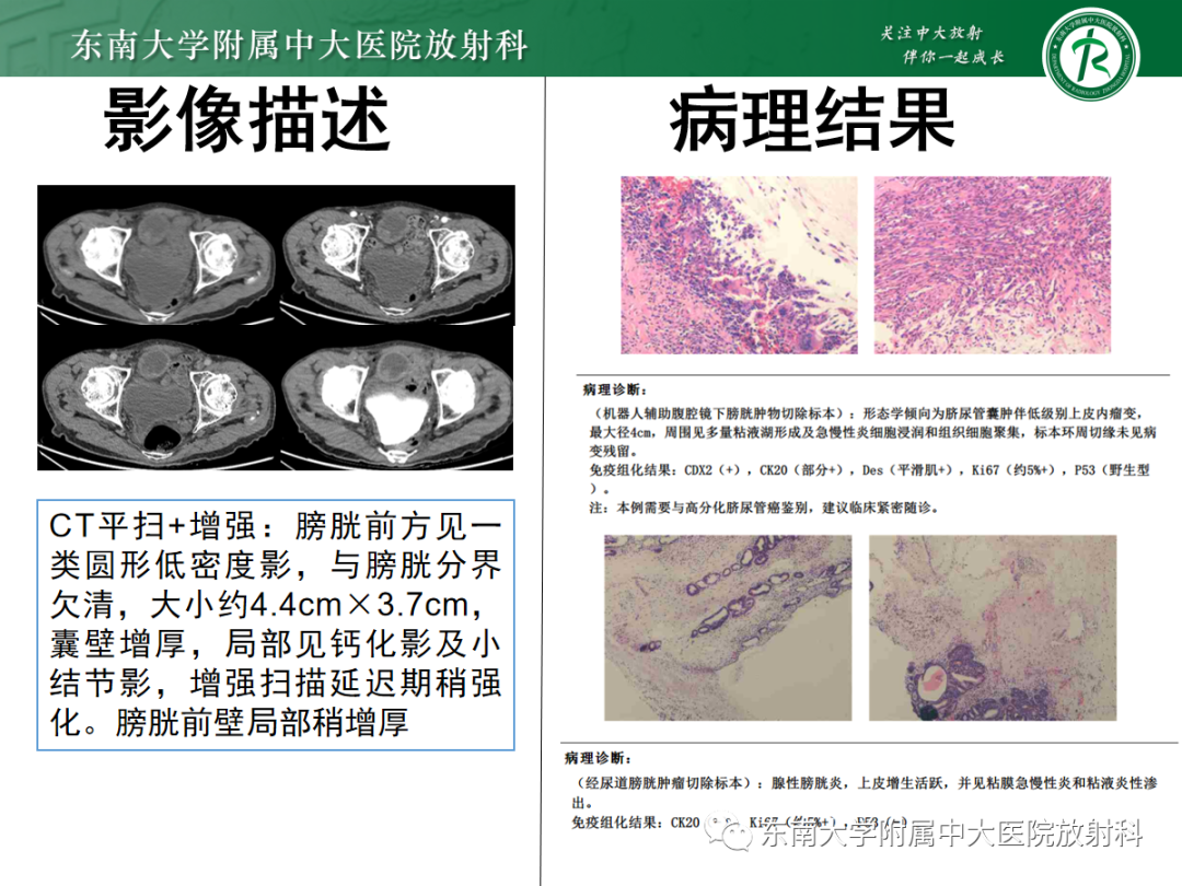 影像PPT - 【PPT】脐尿管病变-3