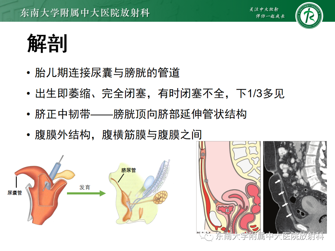 影像PPT - 【PPT】脐尿管病变-5