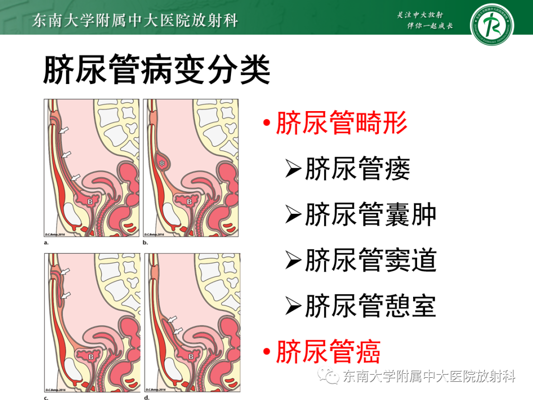 影像PPT - 【PPT】脐尿管病变-6
