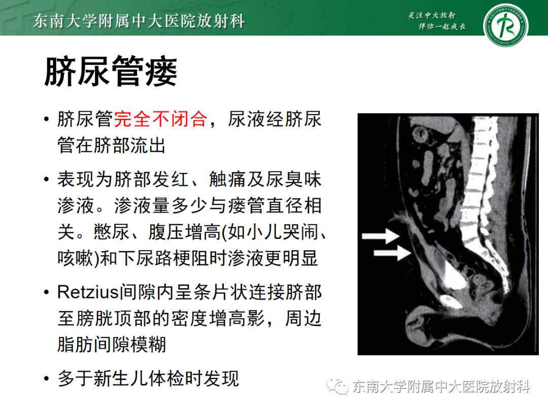 影像PPT - 【PPT】脐尿管病变-7