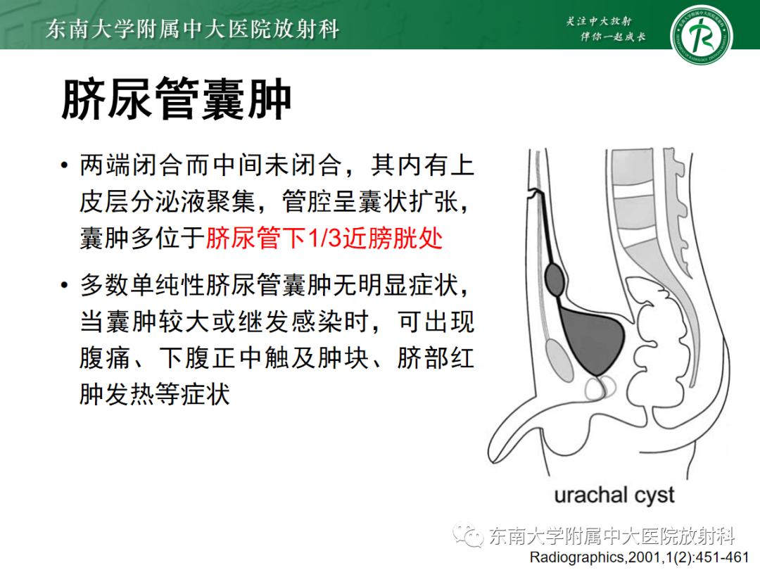 影像PPT - 【PPT】脐尿管病变-8