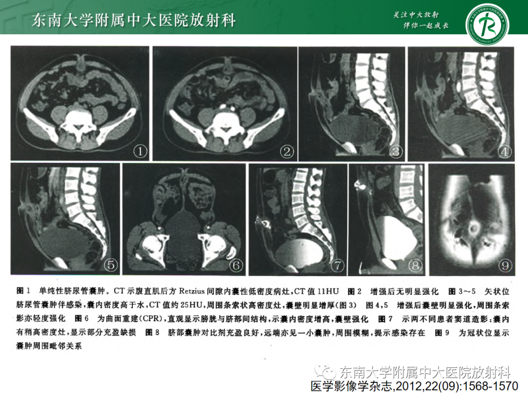 影像PPT - 【PPT】脐尿管病变-11