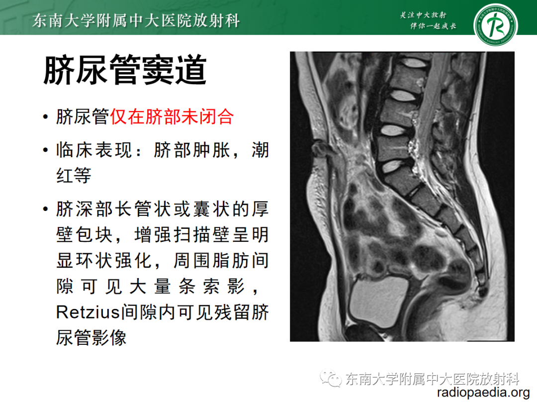 影像PPT - 【PPT】脐尿管病变-12