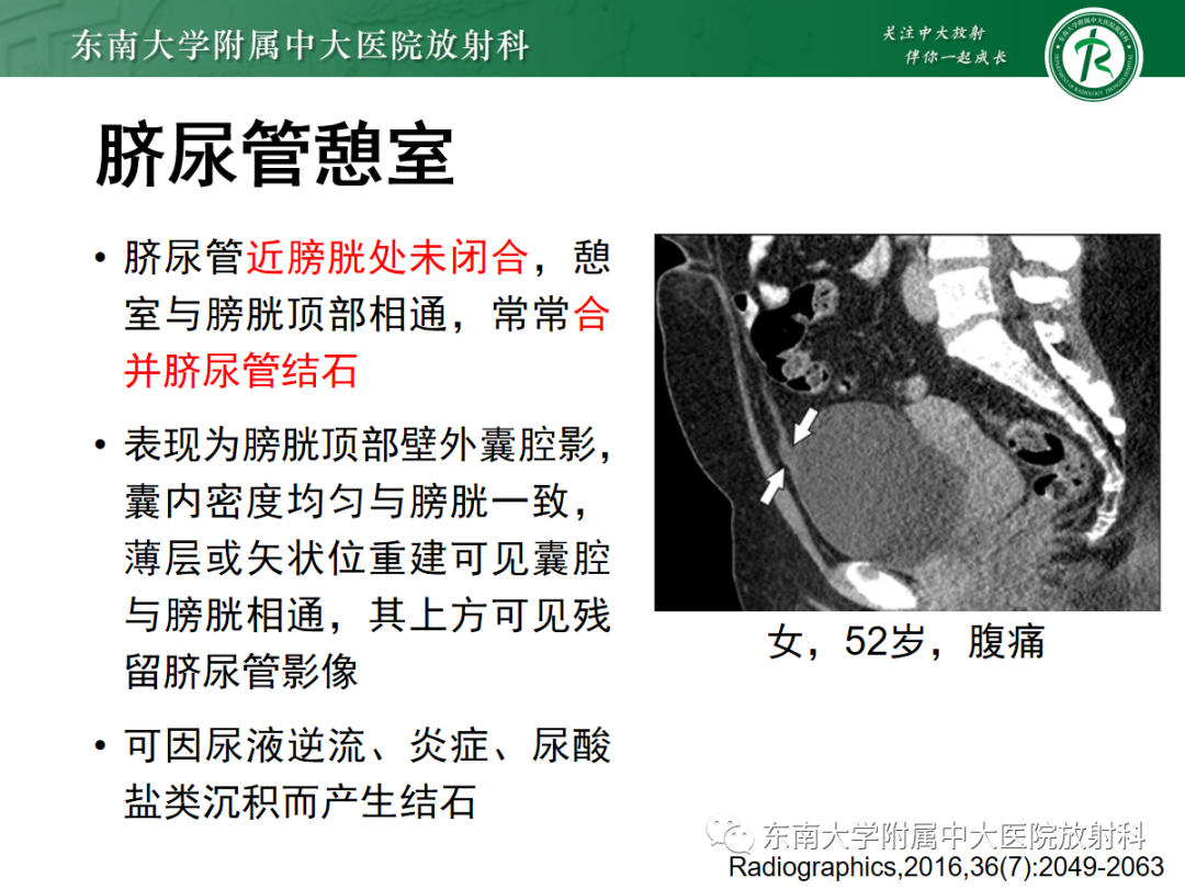 影像PPT - 【PPT】脐尿管病变-13